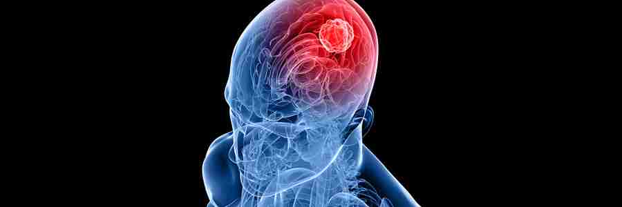 A 3-D image of a human skull and brain depicting cancer